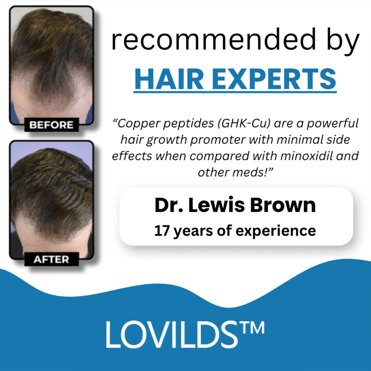 LOVILDS™ Clinically Backed Hair Regrowth Formula Trusted by Experts